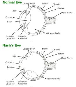 A diagram of what Nash's eye now looks like on the inside.